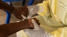 Mehr als 1.000 Tote durch Mpox in Afrika